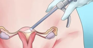 Когда должны пойти месячные после лапароскопии и гистероскопии