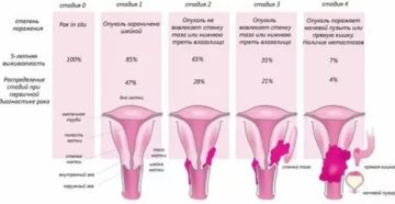 Сколько живут при раке шейки матки степень 2 в