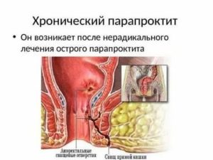 Простатит при парапроктите