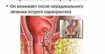 Простатит при парапроктите