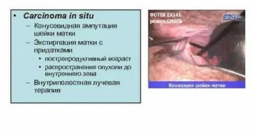 Можно ли вылечить рак шейки матки 4 степени с метастазами