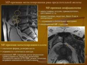 Рак предстательной железы лимфаденопатия