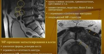 Рак предстательной железы лимфаденопатия