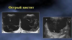 Можно ли выявить цистит по узи