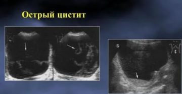 Можно ли выявить цистит по узи