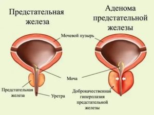 Можно ли париться если аденома предстательной железы