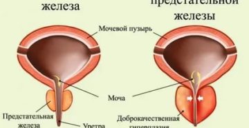 Можно ли париться если аденома предстательной железы
