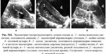 Что означает при узи матки повышенная эхогенность