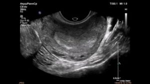 Узи матки при беременности на ранних сроках как проводят