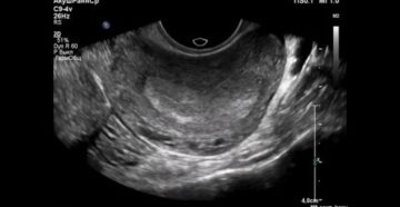 Узи матки при беременности на ранних сроках как проводят