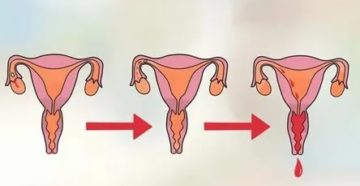 Течение месячных. Длительные менструации. Менструация задержка месячных. Менструация у девственниц. Менструация на утрожестане.