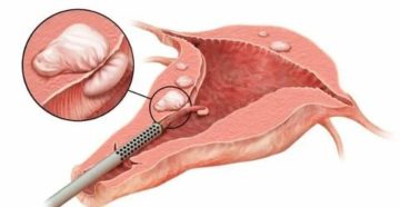 Как лечит эндометрию в матке без операции