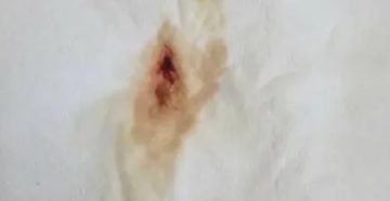 Почему выделяется сукровица после месячных Почему выделяется сукровица после месячных