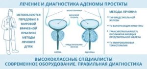 Лечение солью аденомы предстательной железы профессор окулов