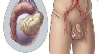 Можно ли заниматься спортом при раке яичка