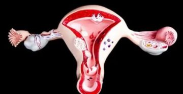 Как протекают месячные при аденомиозе Как протекают месячные при аденомиозе