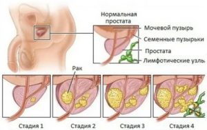 Начальные стадии простатита симптомы и лечение