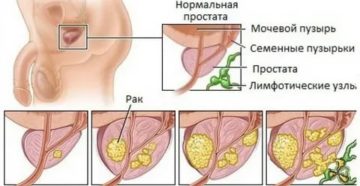 Начальные стадии простатита симптомы и лечение