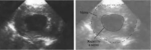 На узи в матке небольшое скопление жидкости что это