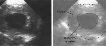 На узи в матке небольшое скопление жидкости что это