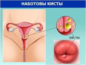 Может ли сама рассосаться киста шейки матки что это такое