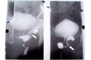 Мочевой свищ и простата