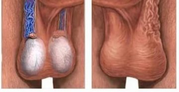Опухоль яичка после операции на варикоцеле