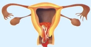 Сколько идет кровь после аборта и месячные Сколько идет кровь после аборта и месячные