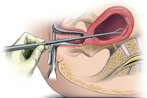 Раздельное диагностическое выскабливание при эндометриозе