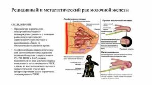 Как проявляется рецидив рака молочной железы