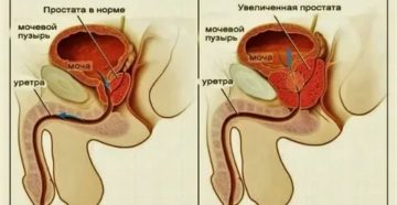 Судороги в области простаты