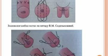 Когда снимают швы с шейки матки после операции