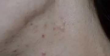 Почему появляются прыщики на груди перед месячными Почему появляются прыщики на груди перед месячными