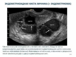 Может ли уменьшиться эндометриоидная киста яичника