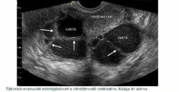 Может ли уменьшиться эндометриоидная киста яичника