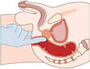 Как найти пальцем простату у мужчины