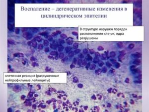 Цитология шейки матки клетки эпителия с дегенеративными изменениями