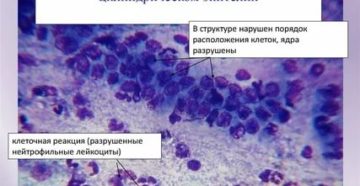 Цитология шейки матки клетки эпителия с дегенеративными изменениями