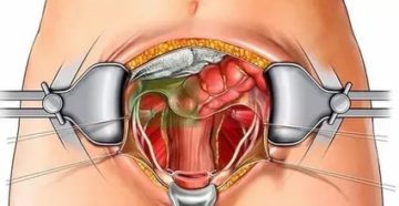 Что нужно делать перед операцией по удалению миомы матки