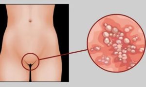 Может ли генитальный герпес вызвать рак