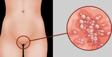 Может ли генитальный герпес вызвать рак