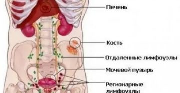 Метастазы в почки при раке предстательной железы