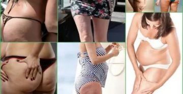 Почему появляется целлюлит перед месячными