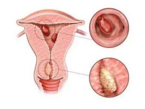 Фиброзные опухоли матки симптомы