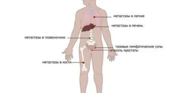 Чем лечат метастазы в легких при раке матки