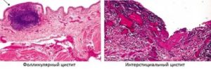 Чем лечить фолликулярный цистит