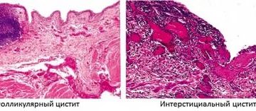 Хронический цистит форум. Полипозный цистит гистология. Хронический цистит гистология. Кистозный цистит гистология. Полип уретры гистология.