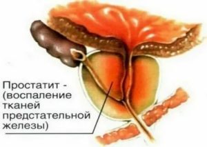 Воспаление предстательной железы на латинском