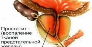 Воспаление предстательной железы на латинском