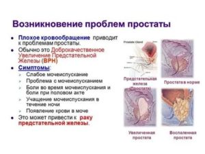 Симптомы аденомы простаты что при этом болит